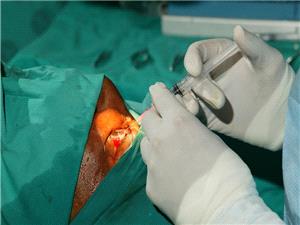 واحده تکفي.. ابتکار حقنه لعلاج العمى