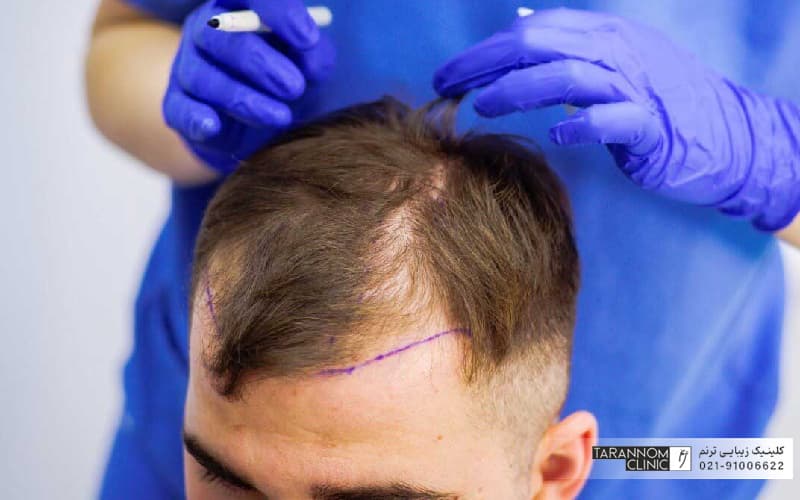 دستان دکتری که لباس و دسکش آبی دارد و ماژیک دستش است و روی سر فرد علامت گذاری میکند برای انجام کاشت مو